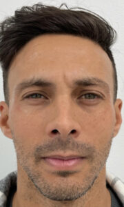 Botox