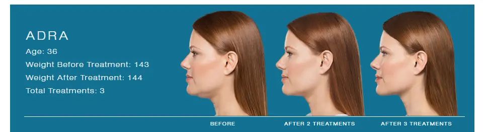 Kybella 1