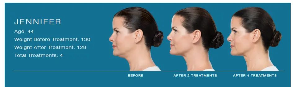 Kybella 3