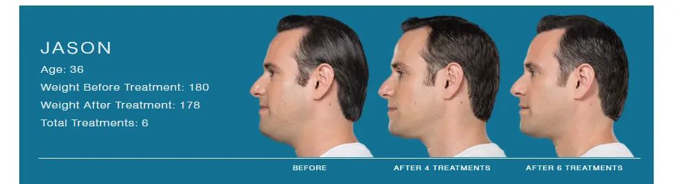 Kybella 4