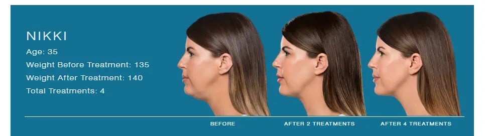 Kybella 5