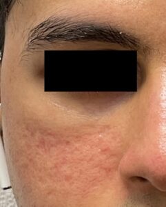 Acne Scarring Morpheus8