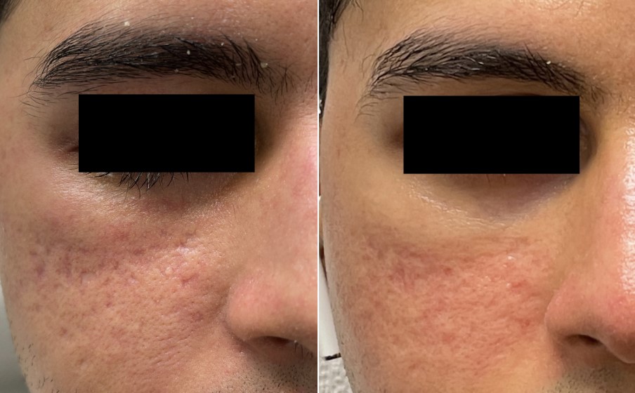 Acne Scarring Morpheus8