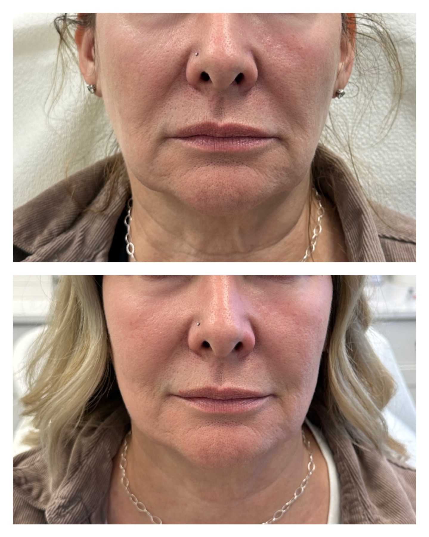 Forma Lower Face