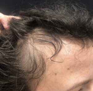 Hair Restoration PRP