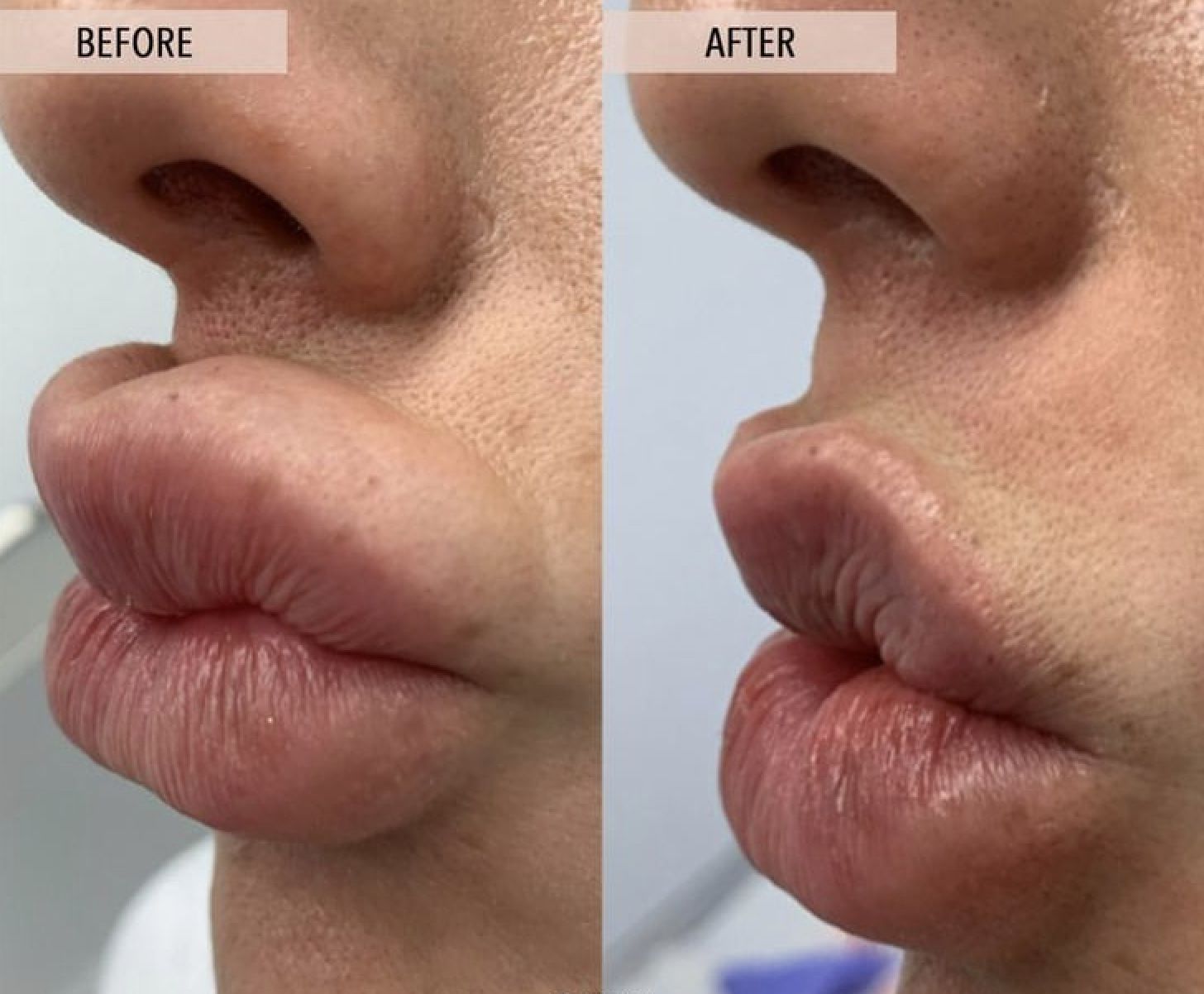 Hylenex Before and After