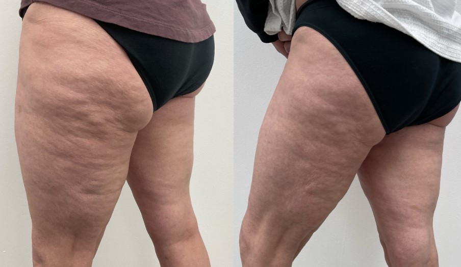 Morpheus8 Body Thighs