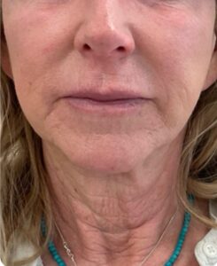 Neck Morpheus8 and Resurfacing