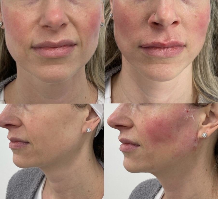 NovaThread Cheek Lift