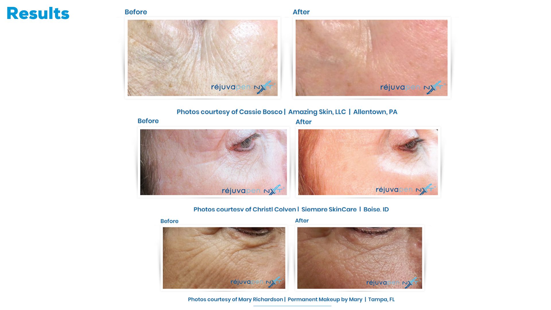Transform Microneedling Rejuvapen