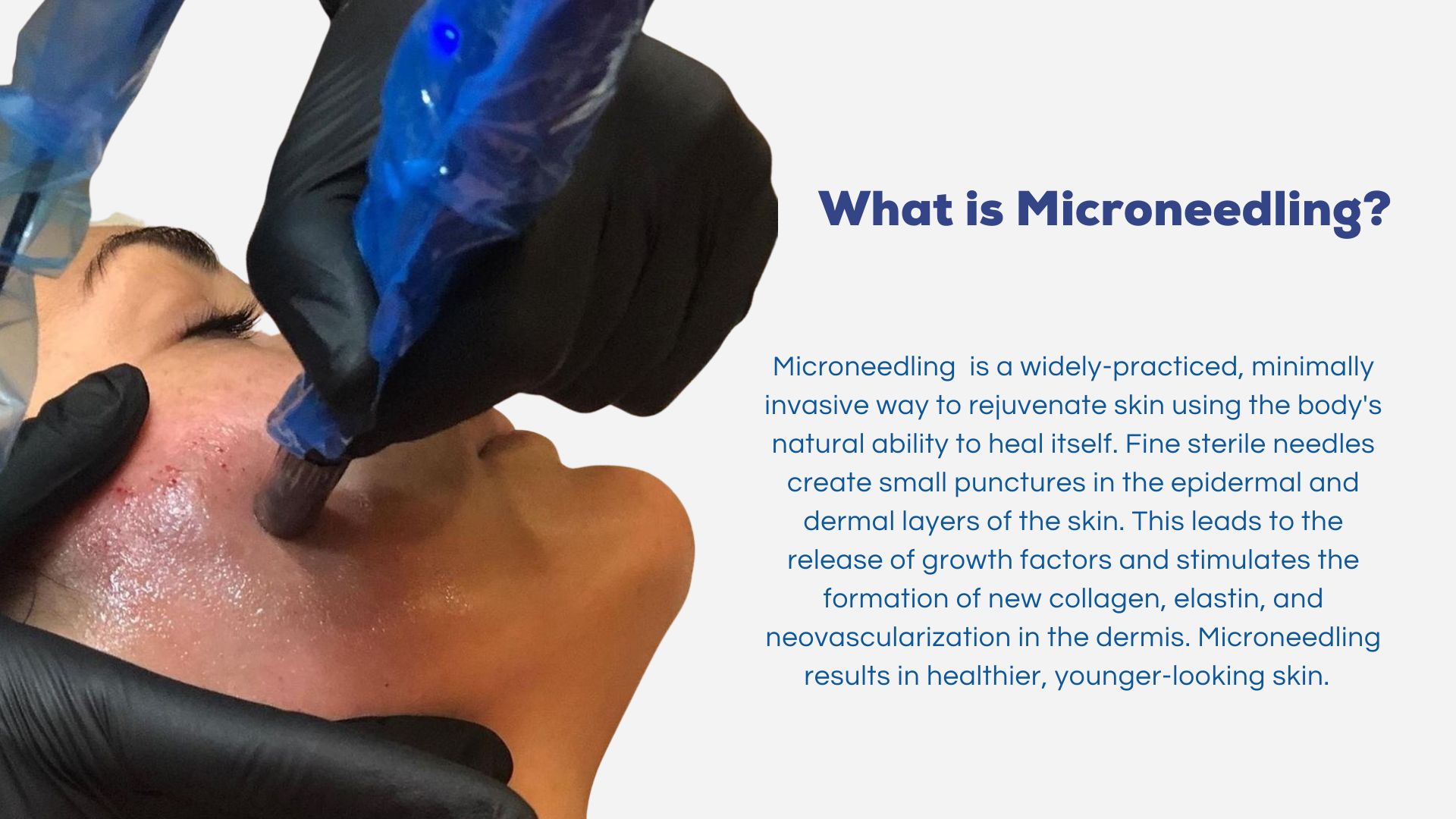 Transform Your Microneedling Rejuvapen