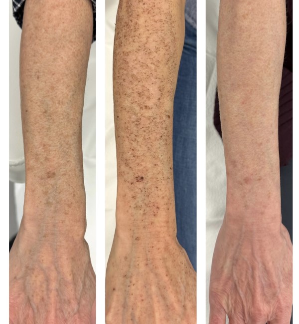 Before & After 1 Treatment Arms