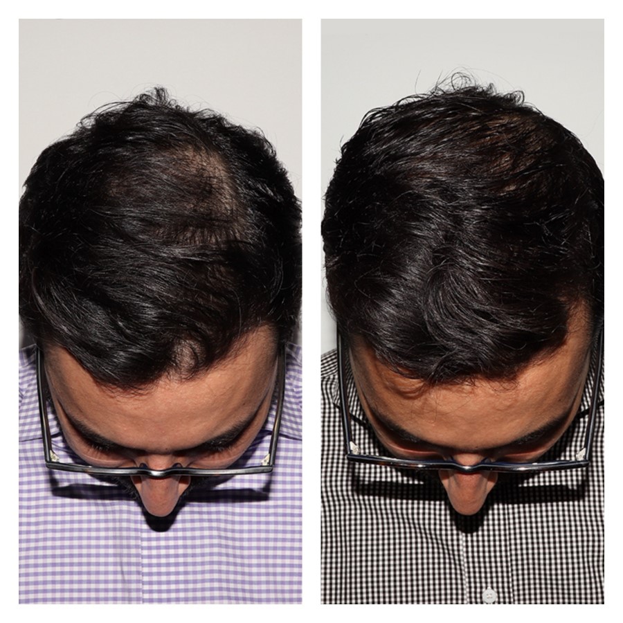 Hair Restoration PRP, Nutrafol