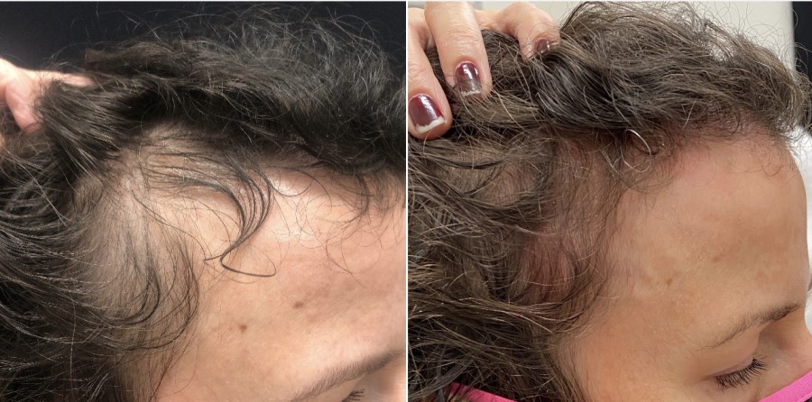 Hair Restoration PRP