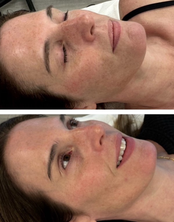 Lumecca IPL