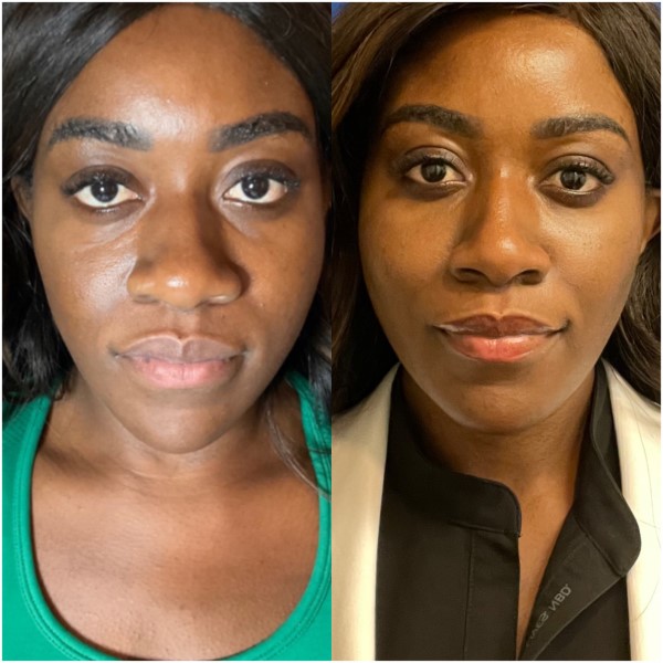 PRP Undereyes