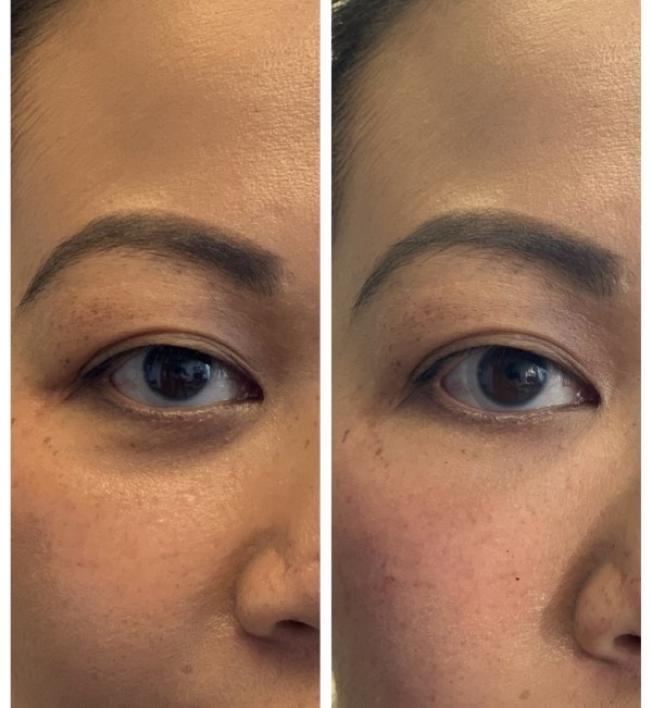 PRP Undereyes 3