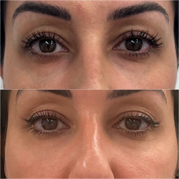 PRP Undereyes