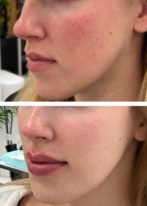Rosacea IPL Treatment