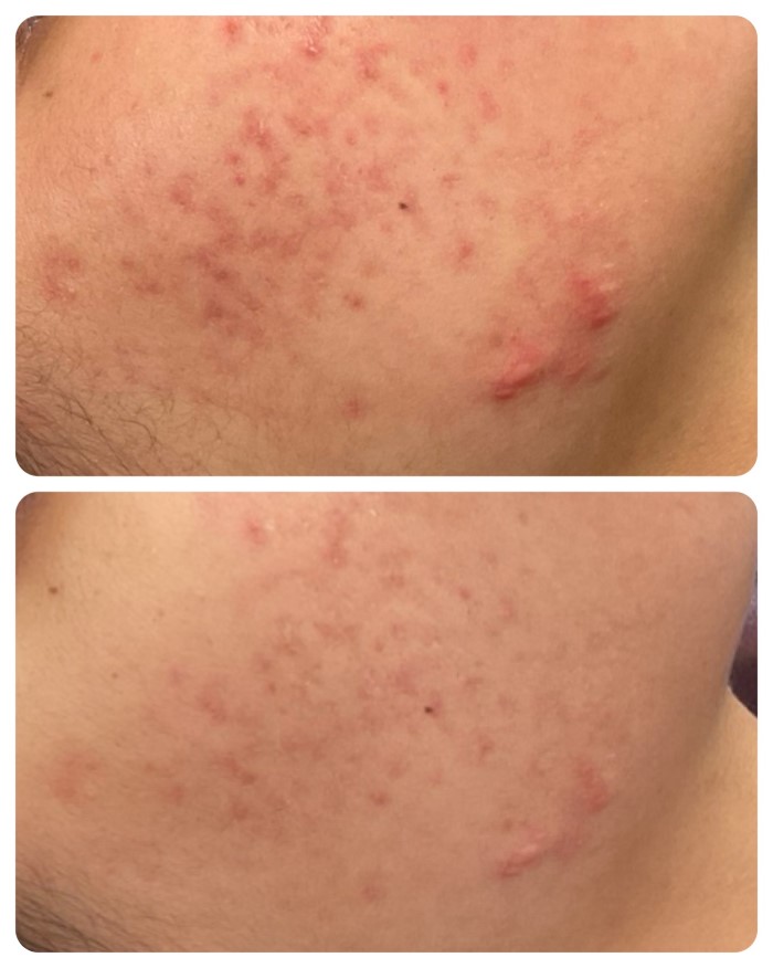 VI Peel Chemical Peel Acne