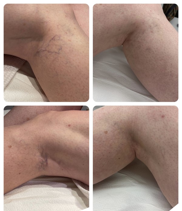 Vasculaze