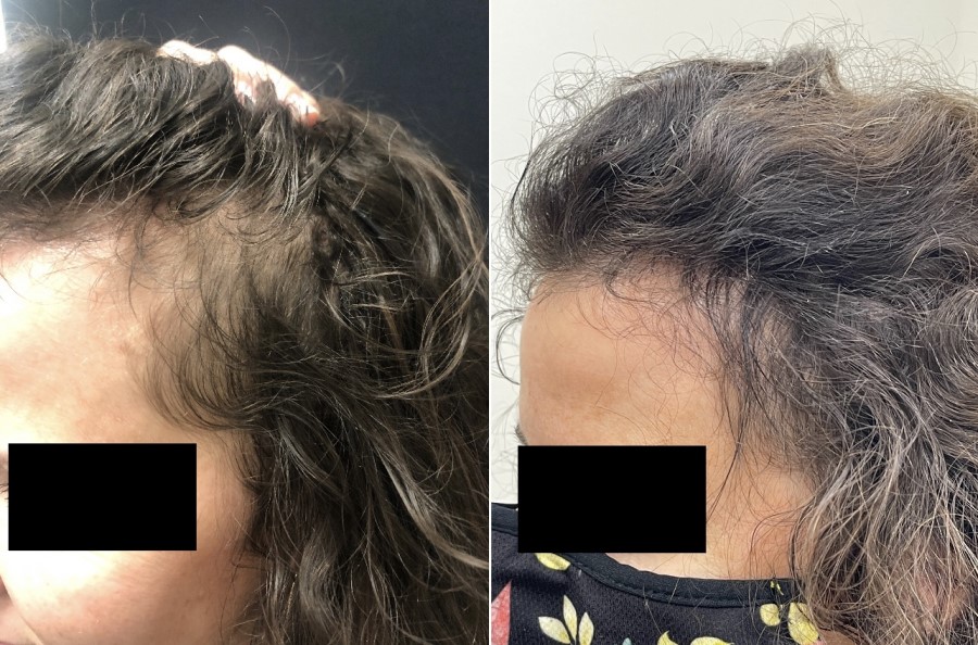 hair restoration before and after