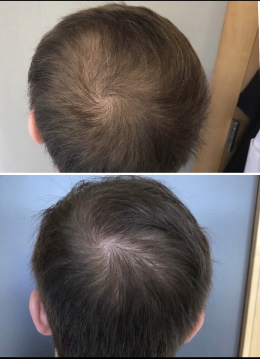prp before and after