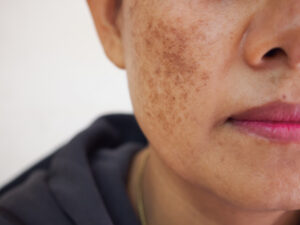 Close up of a patient's face with discolored skin, in need of Lemecca IPL treatment