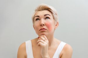 Woman suffering from rosacea on her cheeks and in need of Lumecca IPL therapy