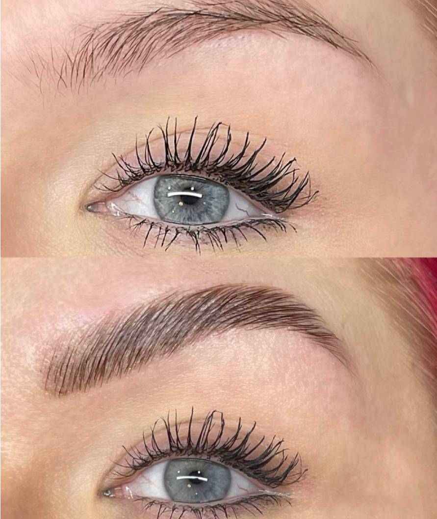 brow before and after cases