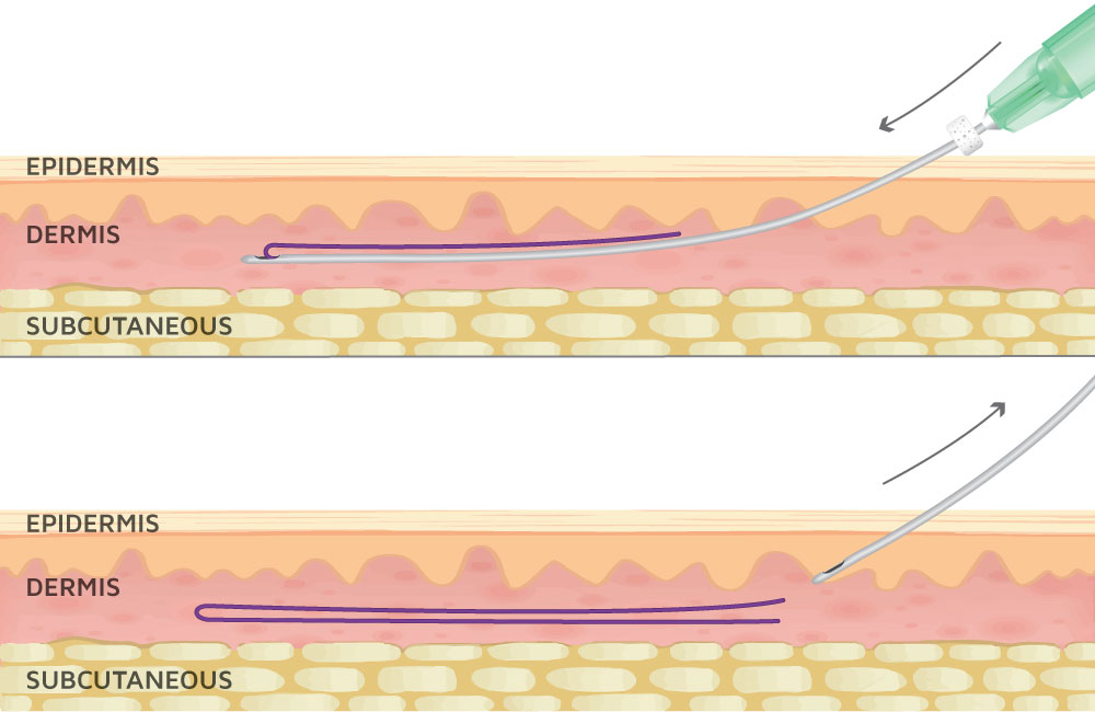 Body Operation Thread NovaThreads Bellevue WA - Injectable PDO Threads Issaquah WA