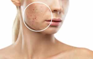 Close up of a young woman with acne scarring on her cheeks, in need of Morpheus8 skin treatment.