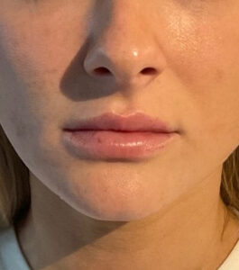 Before Image: Juvéderm Volbella Lip Filler