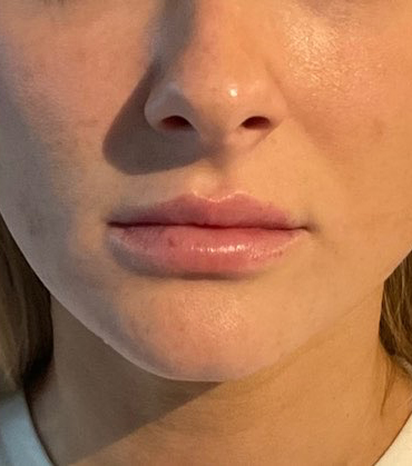 Before Image: Juvéderm Volbella Lip Filler - front