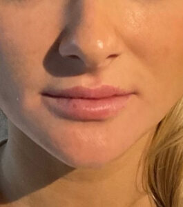 After Image: Juvéderm Volbella Lip Filler