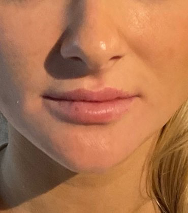 After Image: Juvéderm Volbella Lip Filler - front