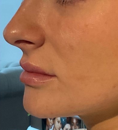 After Image: Juvéderm Volbella Lip Filler - left-side