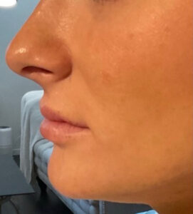 Before Image: Juvéderm Volbella Lip Filler
