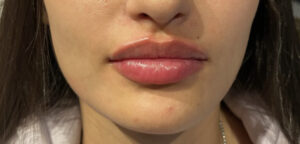 After Image: Juvéderm Volbella Lip Filler