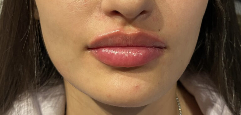 After Image: Juvéderm Volbella Lip Filler - front