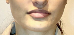 Before Image: Juvéderm Volbella Lip Filler