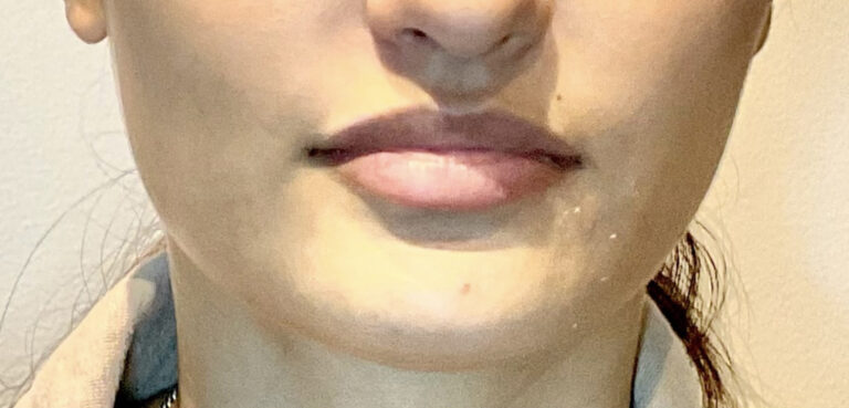 Before Image: Juvéderm Volbella Lip Filler - front