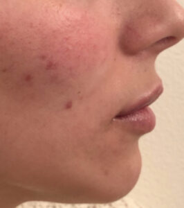 After Image: Juvéderm Volbella Lip Filler