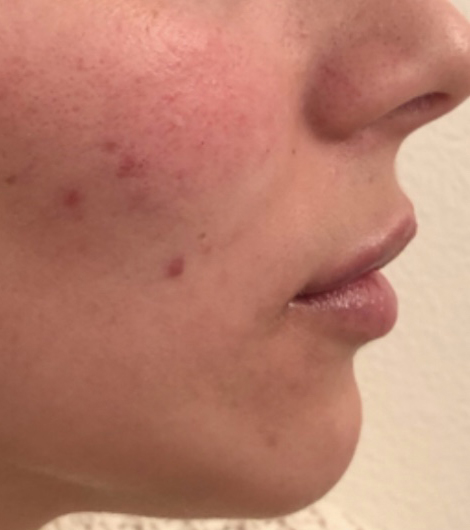 After Image: Juvéderm Volbella Lip Filler - right-side