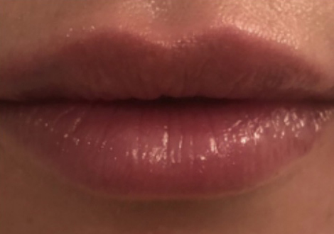 After Image: Juvéderm Volbella Lip Filler - front