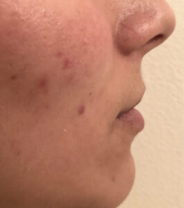 Before Image: Juvéderm Volbella Lip Filler