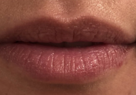 Before Image: Juvéderm Volbella Lip Filler - front