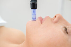 Profile of woman receiving microneedling treatment to her chin and face to lessen the appearance of pores and texture.