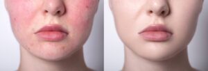 Before and after of a woman receiving Lumecca IPL treatment for skin redness.
